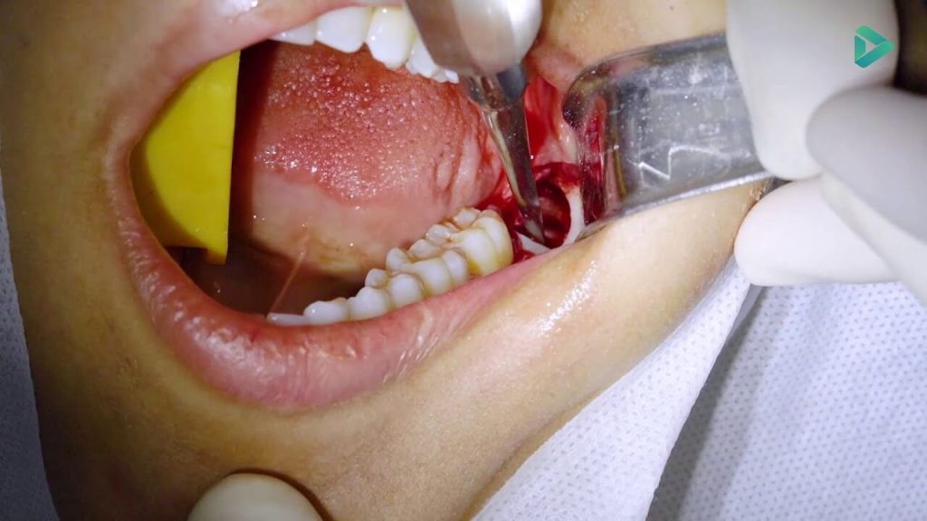 extraindo dente